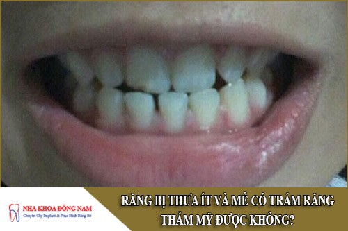răng bị thưa ít và mẻ có trám răng thẩm mỹ được không