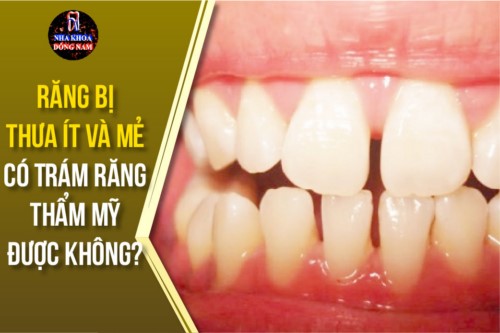 răng bị thưa ít và mẻ có trám răng thẩm mỹ được không