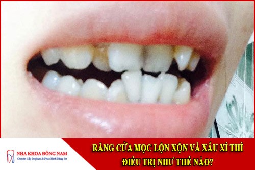 răng cửa mọc lộn xộn và xấu xí thì điều trị như thế nào