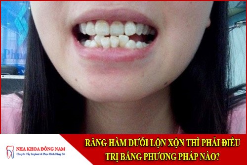 răng hàm dưới lộn xộn thì phải điều trị bằng phương pháp nào