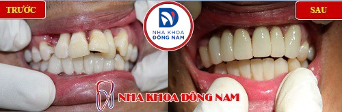răng hàm dưới lộn xộn thì phải điều trị bằng phương pháp nào 1