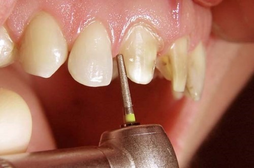 răng hàm dưới lộn xộn thì phải điều trị bằng phương pháp nào 3