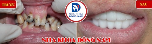 răng hàm dưới lộn xộn thì phải điều trị bằng phương pháp nào 4