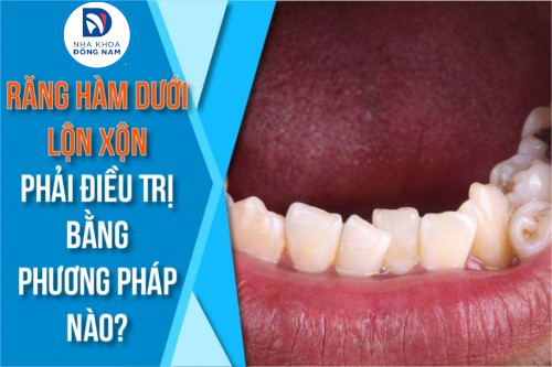răng hàm dưới lộn xộn thì phải điều trị bằng phương pháp nào