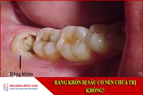răng khôn bị sâu có nên chữa trị không