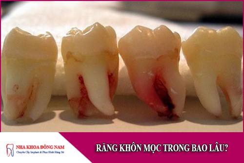 răng khôn mọc trong bao lâu