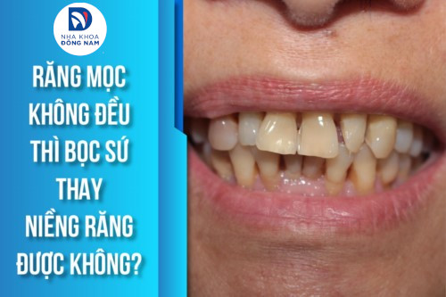 răng mọc không đều thì có bọc răng sứ thay niềng răng được không