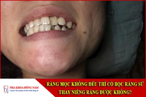răng mọc không đều thì có bọc răng sứ thay niềng răng được không