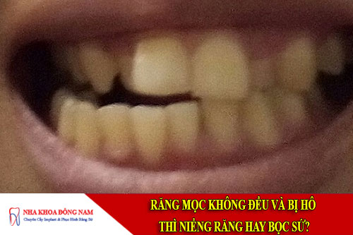 răng mọc không đều và bị hô thì niềng răng hay bọc sứ?
