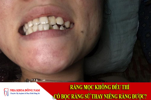 răng mọc không đều thì có bọc răng sứ thay niềng răng được
