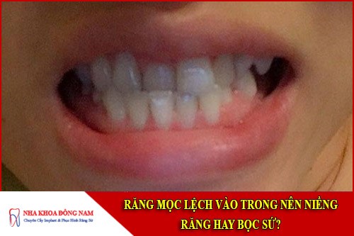 răng mọc lệch vào trong nên niềng răng hay bọc sứ