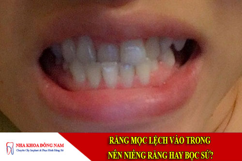 răng mọc lệch vào trong nên niềng răng hay bọc sứ