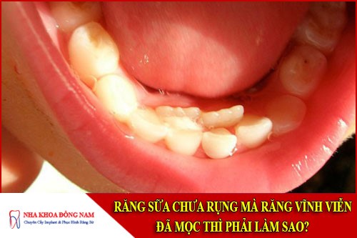 răng sữa chưa rụng mà răng vĩnh viễn đã mọc thì phải làm sao
