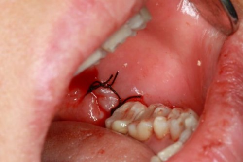 nguyên nhân chảy máu hoài sau khi nhổ răng