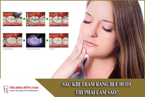 sau khi trám răng bị ê buốt thì phải làm sao