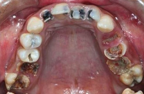 sâu răng có tự khỏi không 1