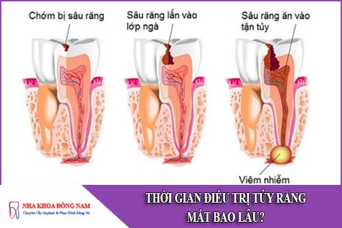thời gian điều trị tủy răng mất bao lâu