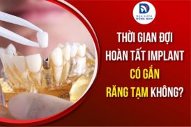 Thời Gian Đợi Hoàn Tất Implant Có Gắn Răng Tạm Không?