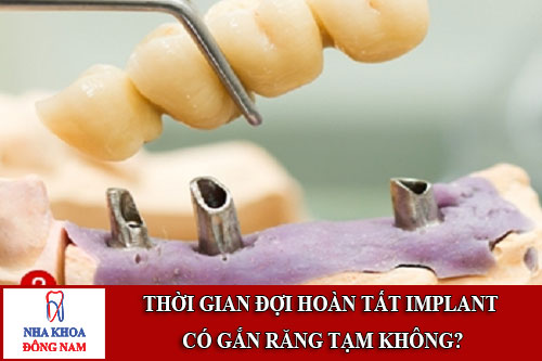 thời gian đợi hoàn tất implant có gắn răng tạm không?