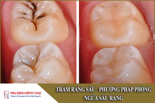trám răng sâu - phương pháp phòng ngừa sâu răng