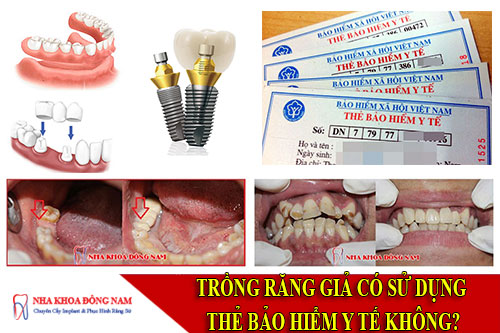 trồng răng giả có sử dụng bảo hiểm y tế không