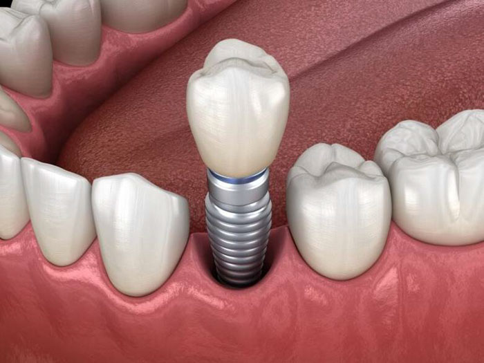 Trồng răng Implant cho trường hợp mất 1 răng