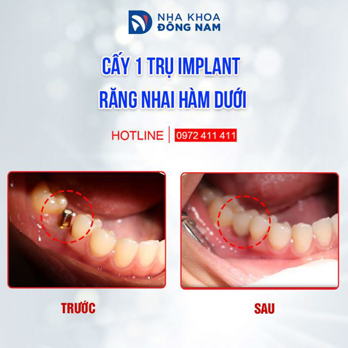 Trồng răng Implant là giải pháp trồng răng toàn diện nhất