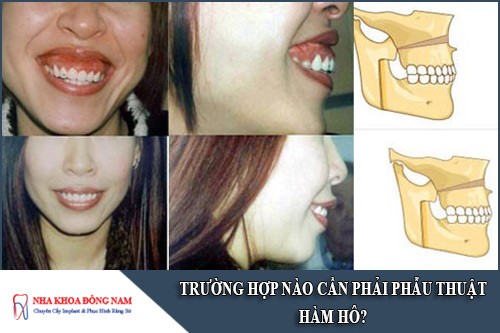 trường hợp nào cần phẫu thuật hàm hô
