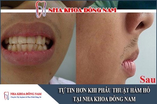tự tin hơn khi phẫu thuật hàm hô tại nha khoa đông nam