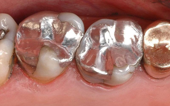 Vật liệu trám Amalgam