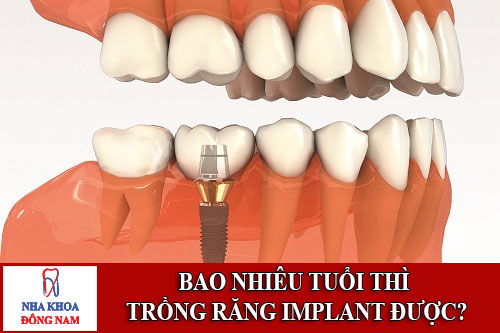 bao nhiêu tuổi thì trồng răng implant được1