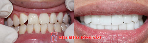 bọc răng sứ 16 cái zirconia 22092016