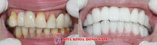 bọc răng sứ 2 hàm zirconia 22092016