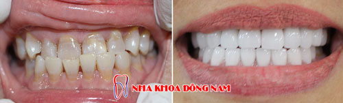 bọc răng sứ 20 cái Zirconia -22082016
