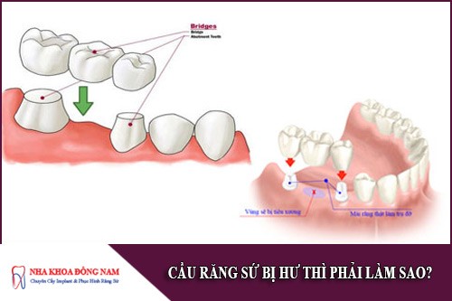 cầu răng sứ bị hư thì phải làm sao