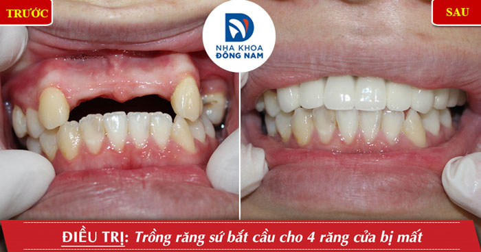 Cầu răng sứ đem lại thẩm mỹ tốt không khác gì răng thật