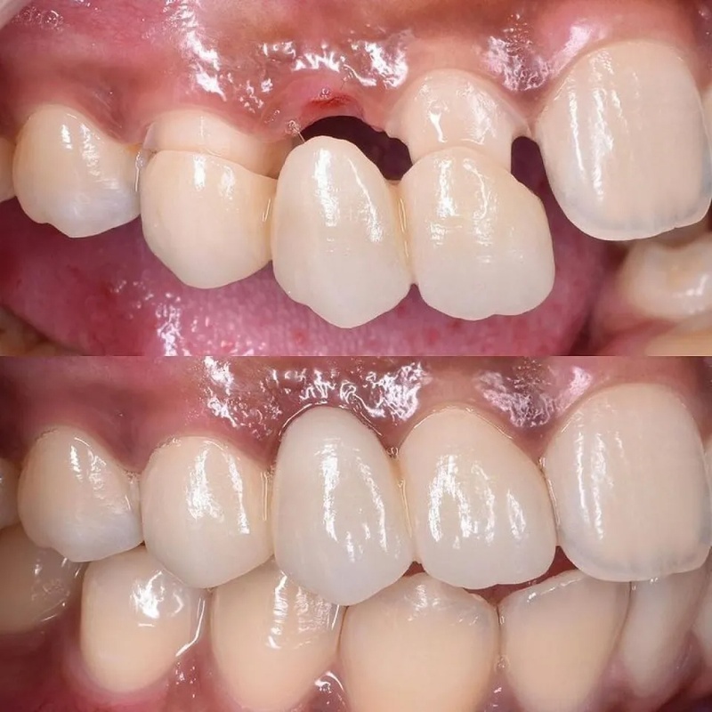 Cầu răng sứ giúp cải thiện thẩm mỹ tối ưu và chức năng ăn nhai tốt