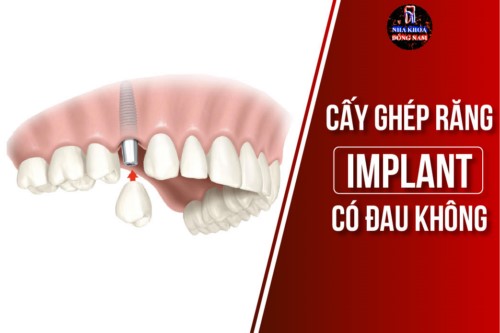 cấy ghép răng implant có đau không