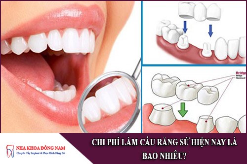 chi phí làm cầu răng sứ hiện nay bao nhiêu