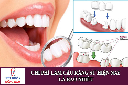 chi phí làm cầu răng sứ hiện nay là bao nhiêu
