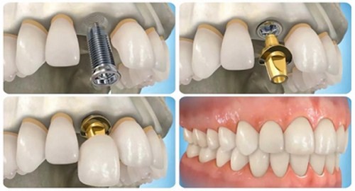 mô phỏng kỹ thuật trồng răng sứ trên implant