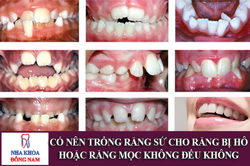có nên trồng răng sứ cho răng bị hô hoặc răng mọc không đều không