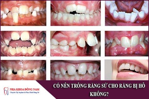 có nên trồng răng sứ cho răng bị hô không