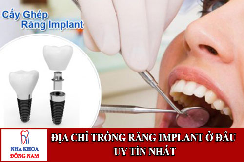 địa chỉ trồng răng implant ở đâu uy tín nhất