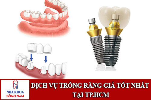 dịch vụ trồng răng giả tốt nhất tại tp.hcm