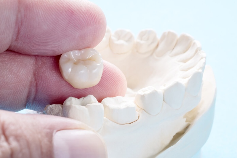 Gắn răng tạm giúp giữ tính thẩm mỹ cho răng