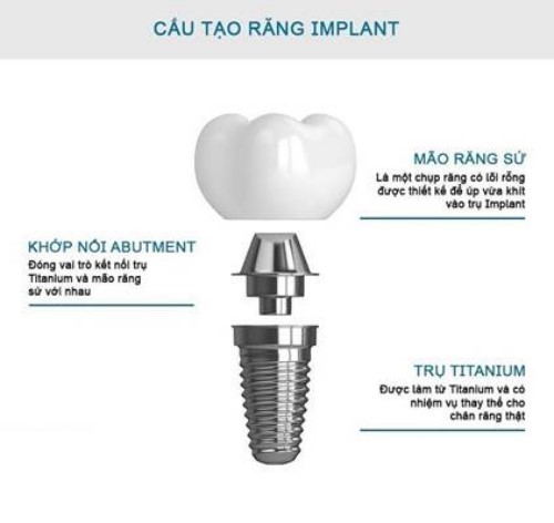 cấu tạo của răng implant