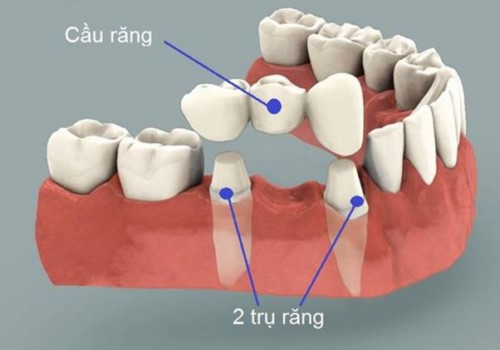 cấu tạo của cầu răng sứ