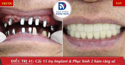 cấy ghép implant toàn hàm