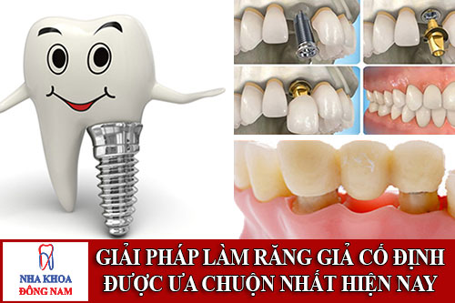 giải pháp làm răng giả cố định được ưa chuộn nhất hiện nay